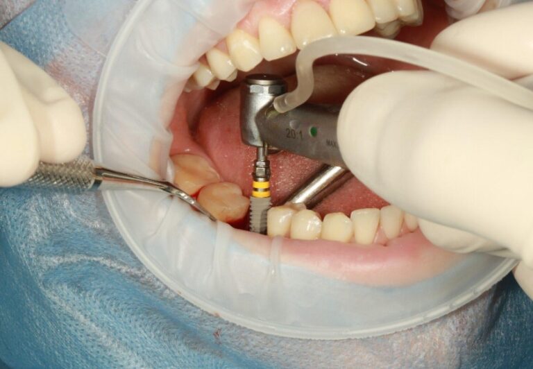 Personalized Cosmetic Dental Implant Treatments by Experts
